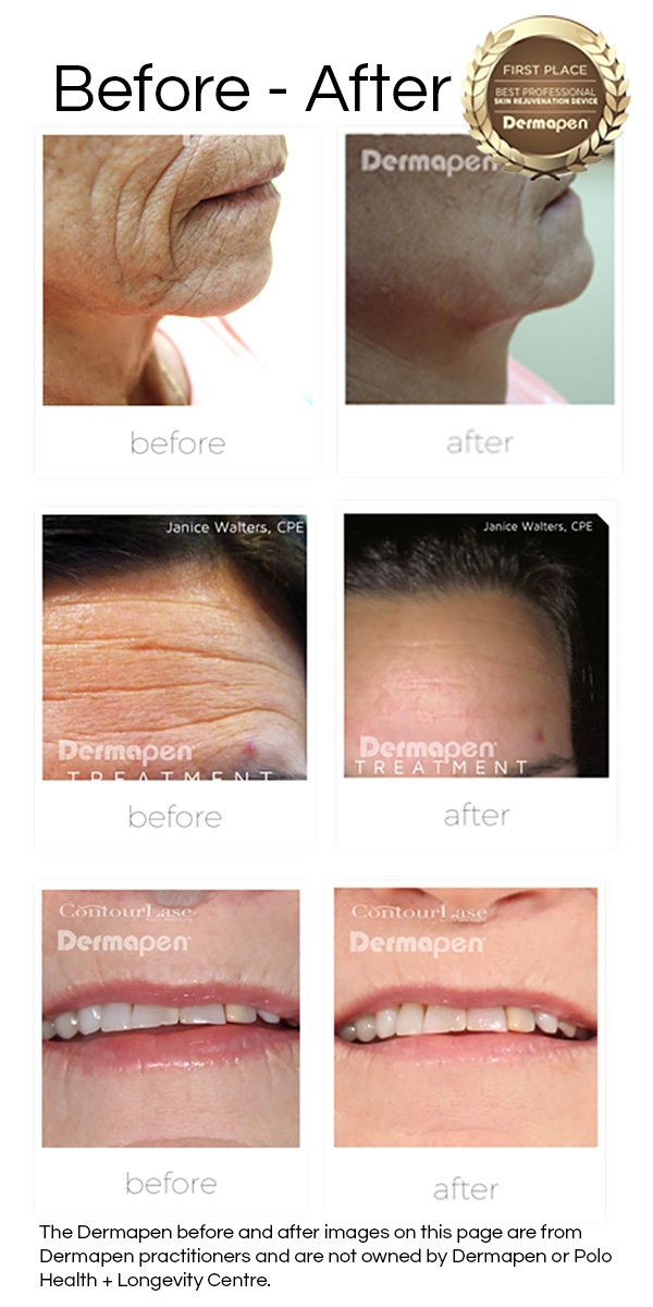 before after pics dermapen