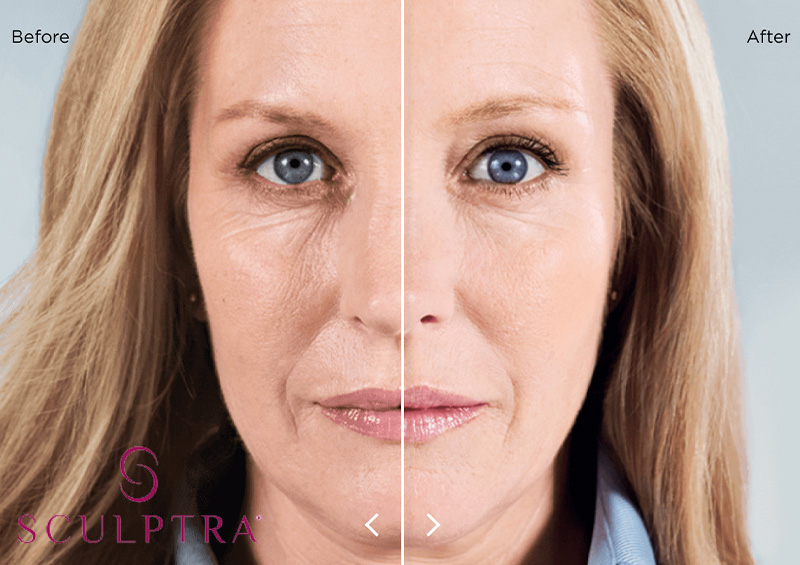 sculptra