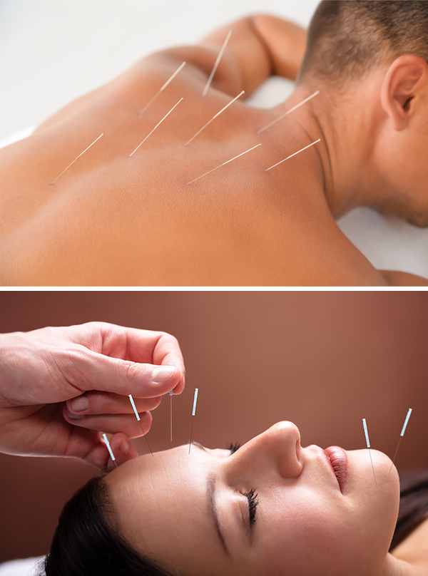 Acupuncture