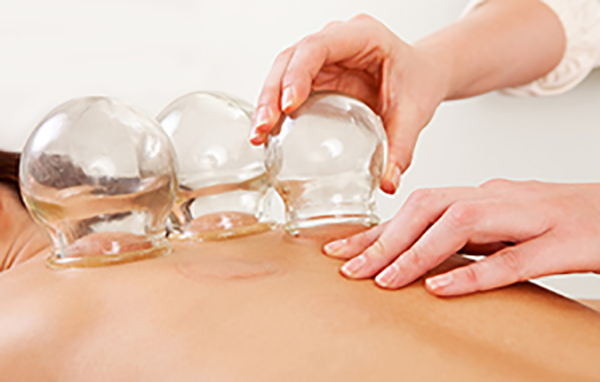 Cupping Acupuncture New Westminster